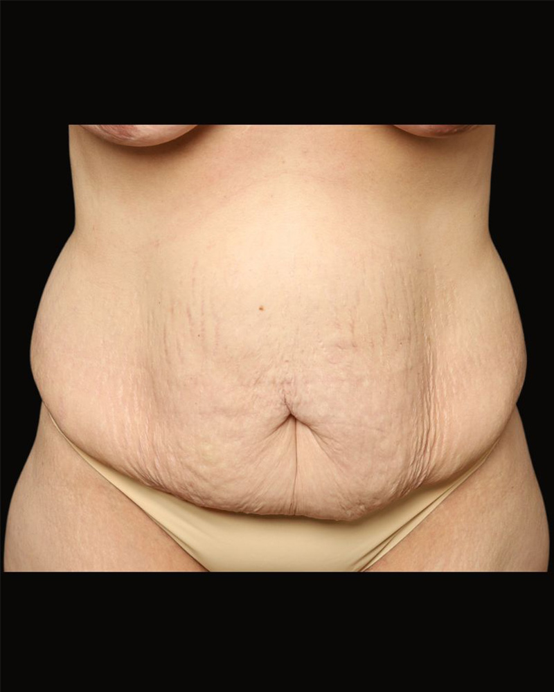 Tummy Tuck Before and After 06