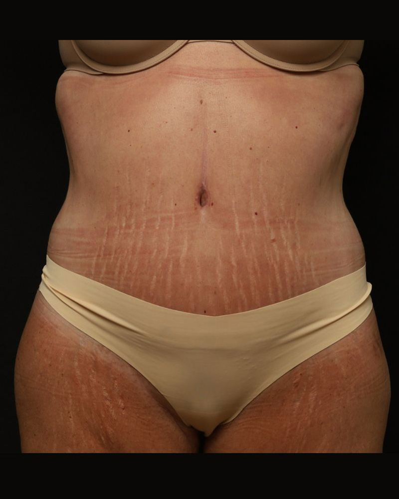 Tummy Tuck Before and After 07