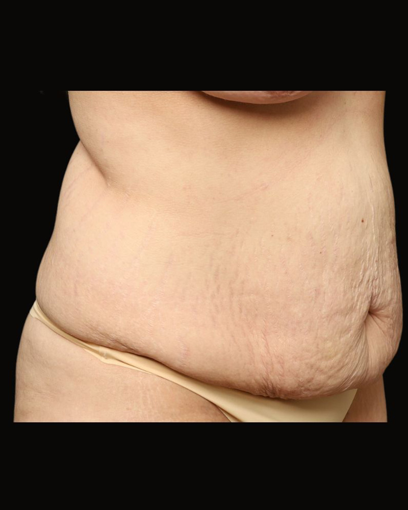 Tummy Tuck Before and After 06