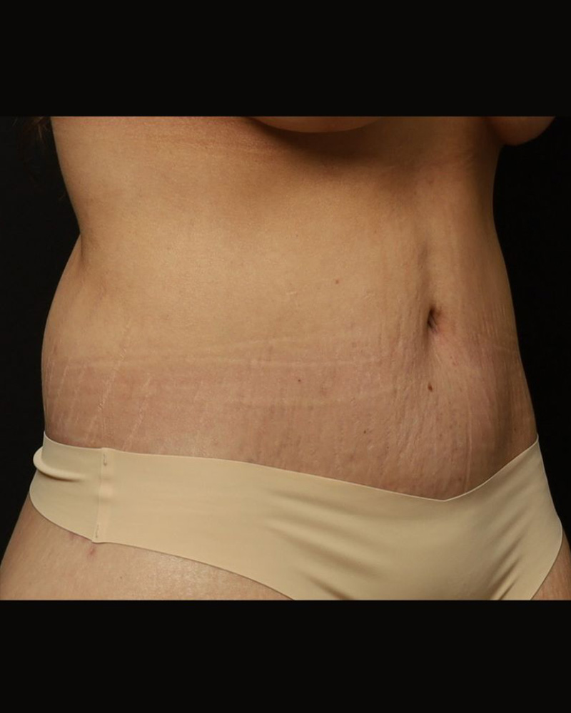 Tummy Tuck Before and After 06