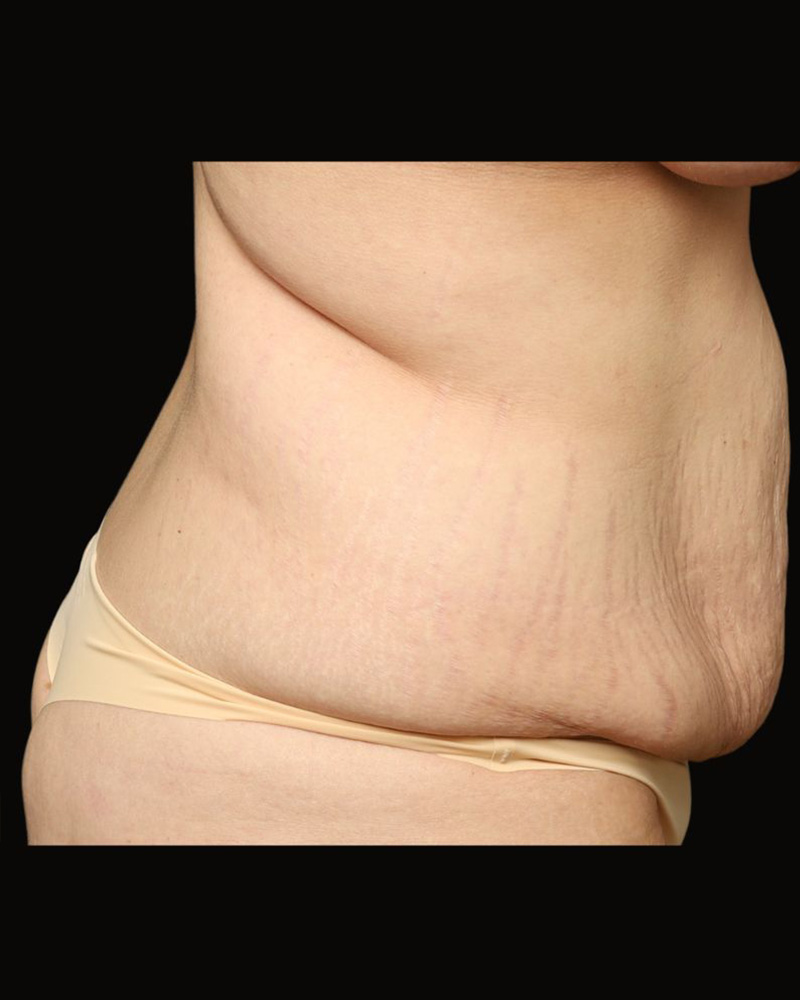 Tummy Tuck Before and After 06