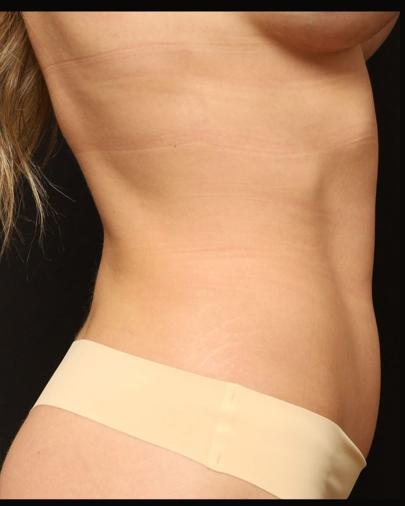 Tummy Tuck Before and After 07