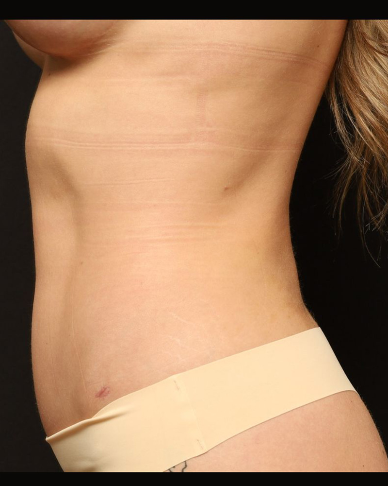 Tummy Tuck Before and After 07