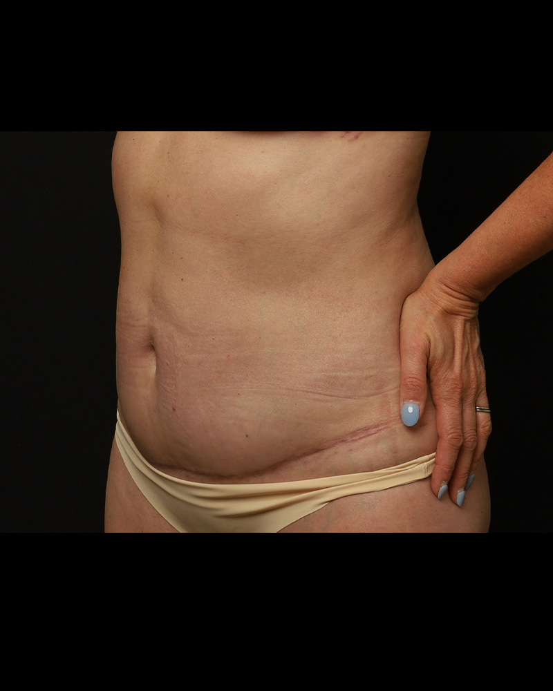 Tummy Tuck Before and After 07