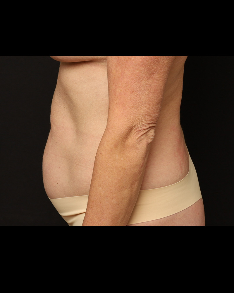Tummy Tuck Before and After 07