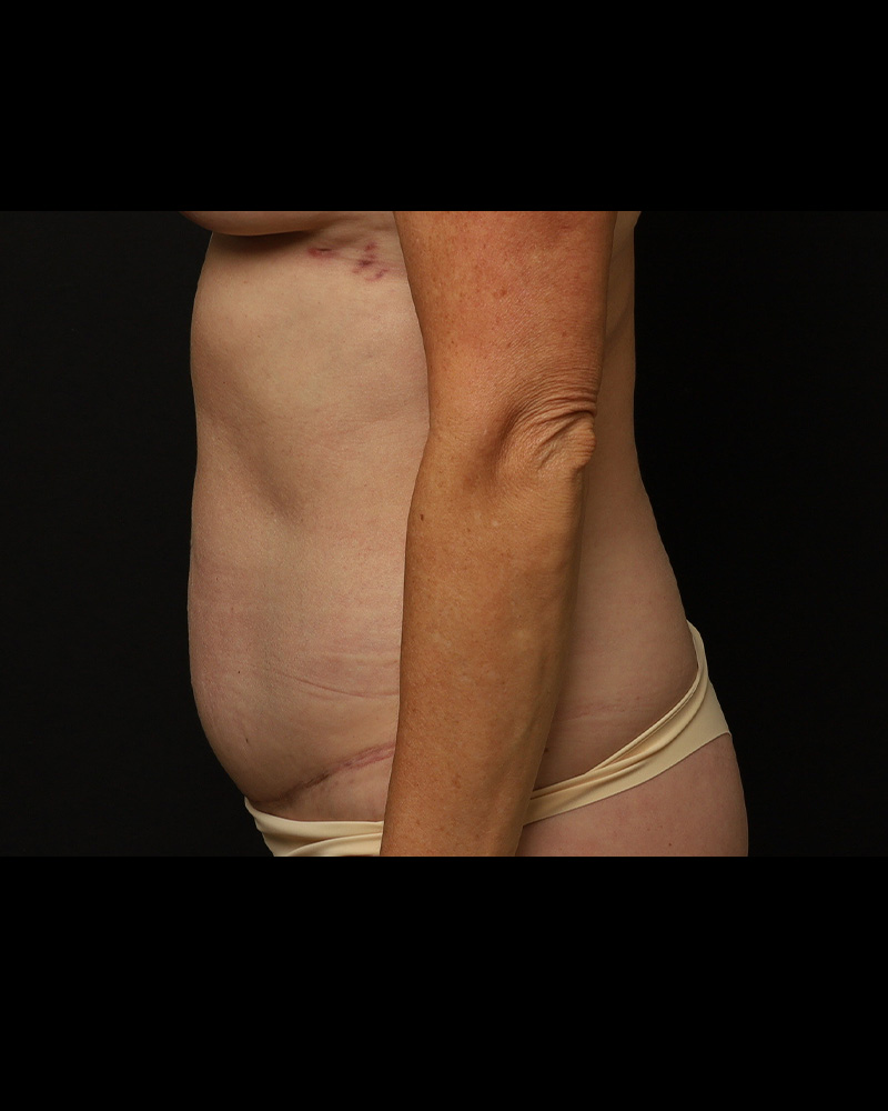 Tummy Tuck Before and After 07