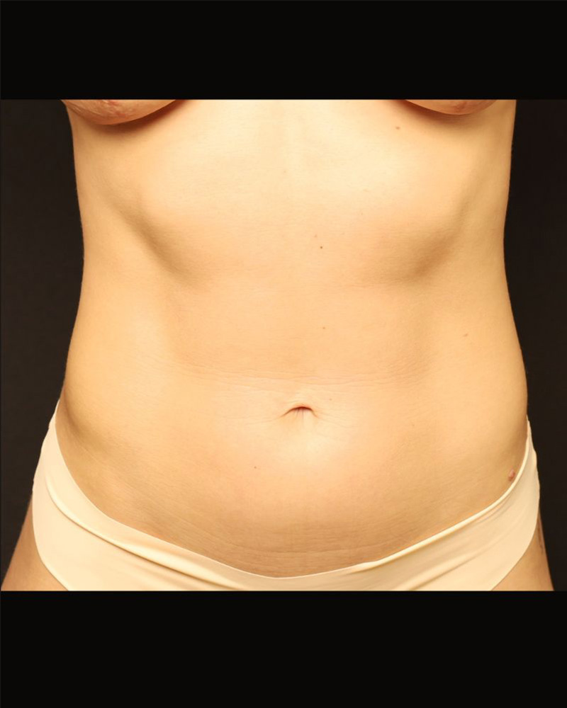 Tummy Tuck Before and After 08