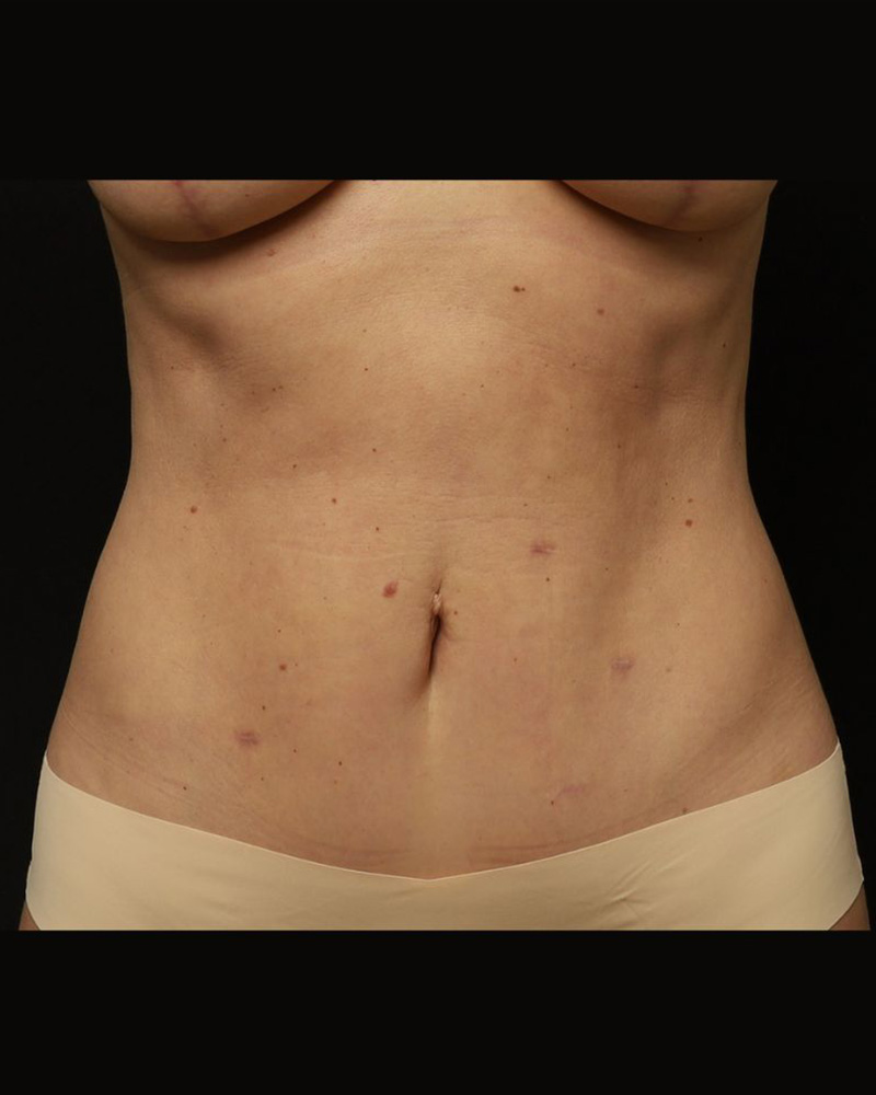 Tummy Tuck Before and After 07
