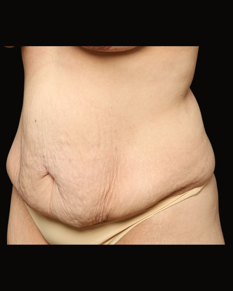 Tummy Tuck Before and After 08