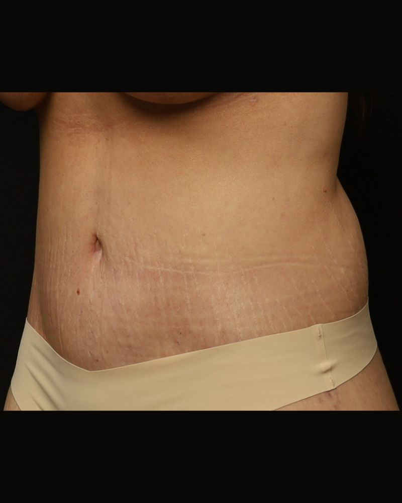 Tummy Tuck Before and After 08
