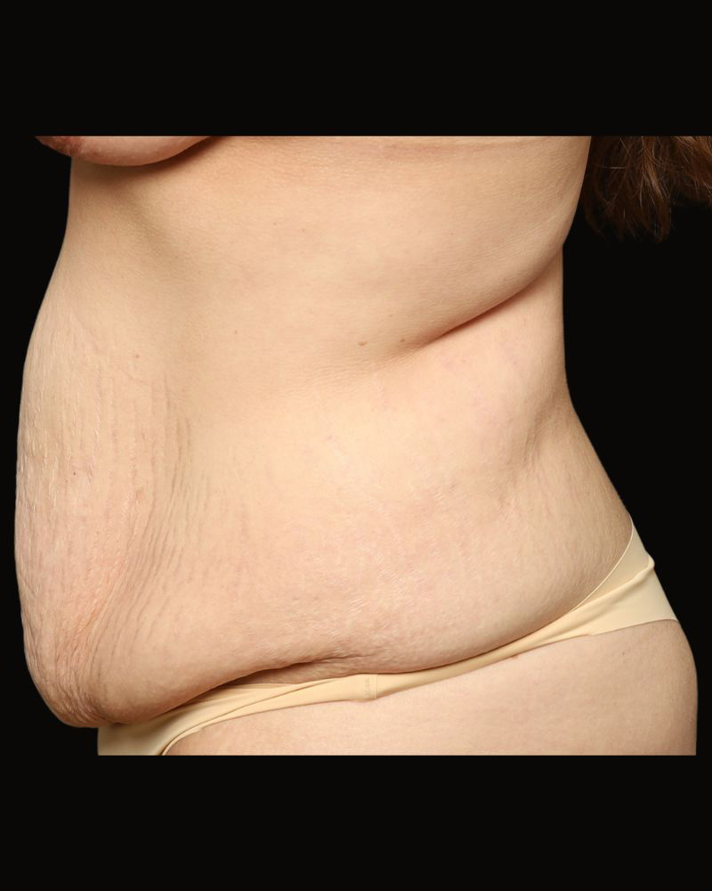 Tummy Tuck Before and After 08