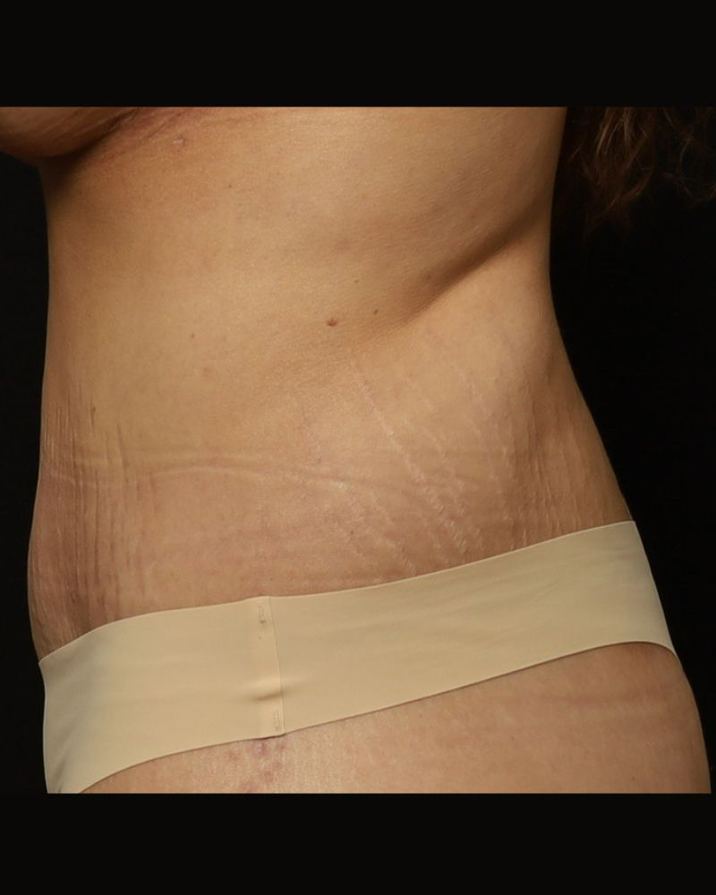 Tummy Tuck Before and After 08
