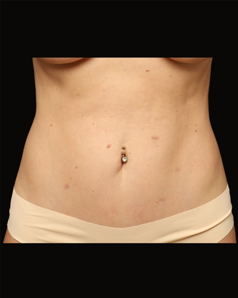 Tummy Tuck Before and After 09