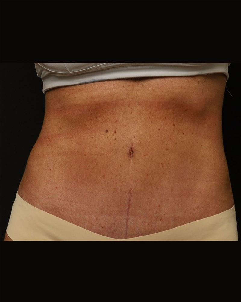 Tummy Tuck Before and After 07