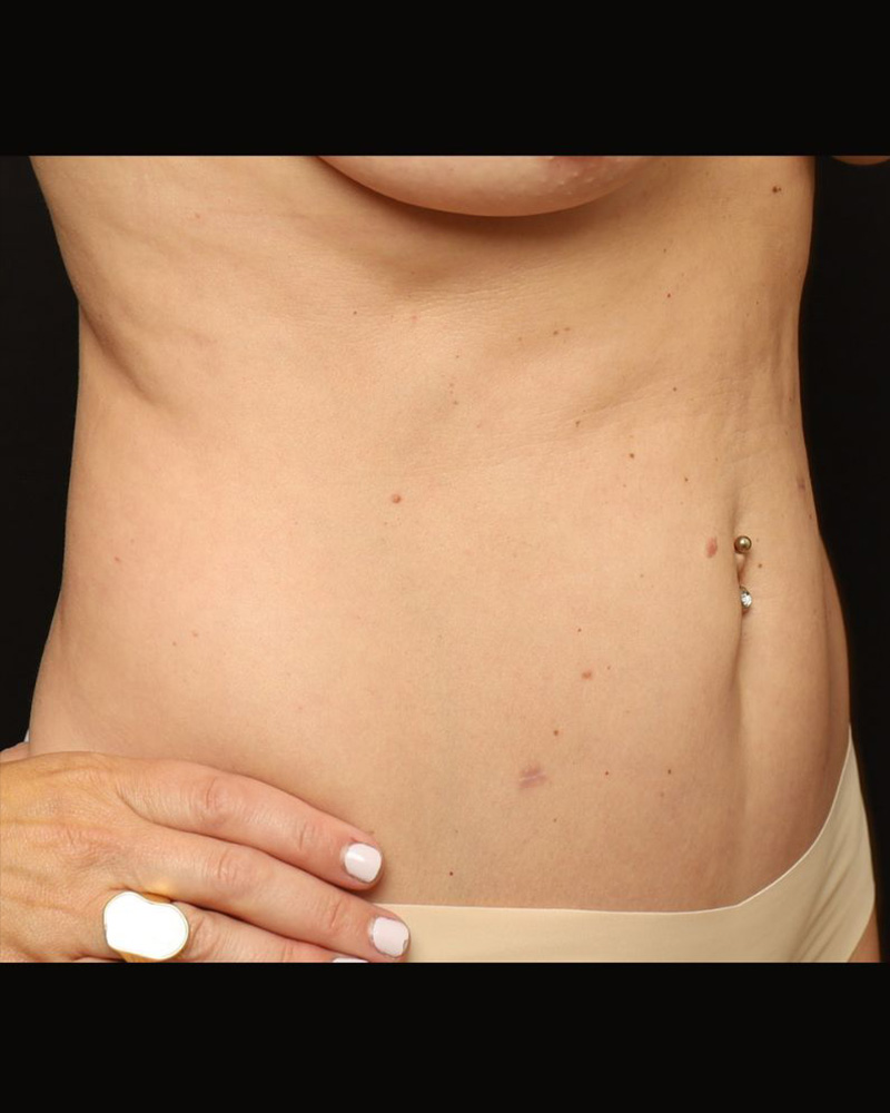 Tummy Tuck Before and After 09