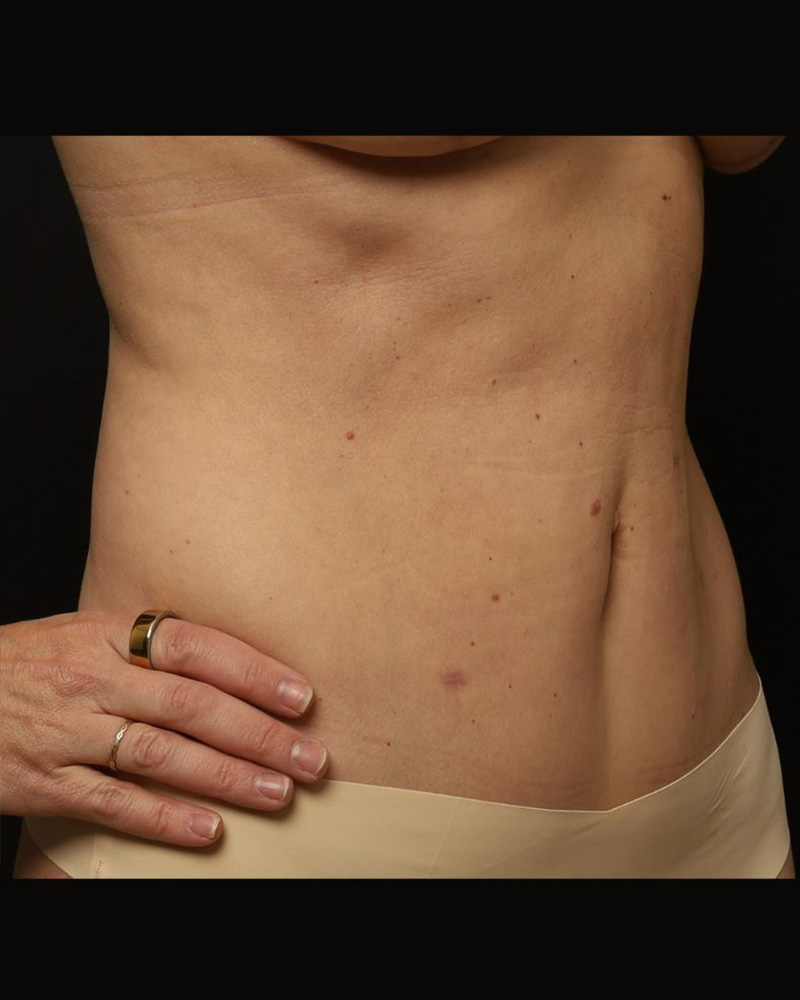 Tummy Tuck Before and After 09