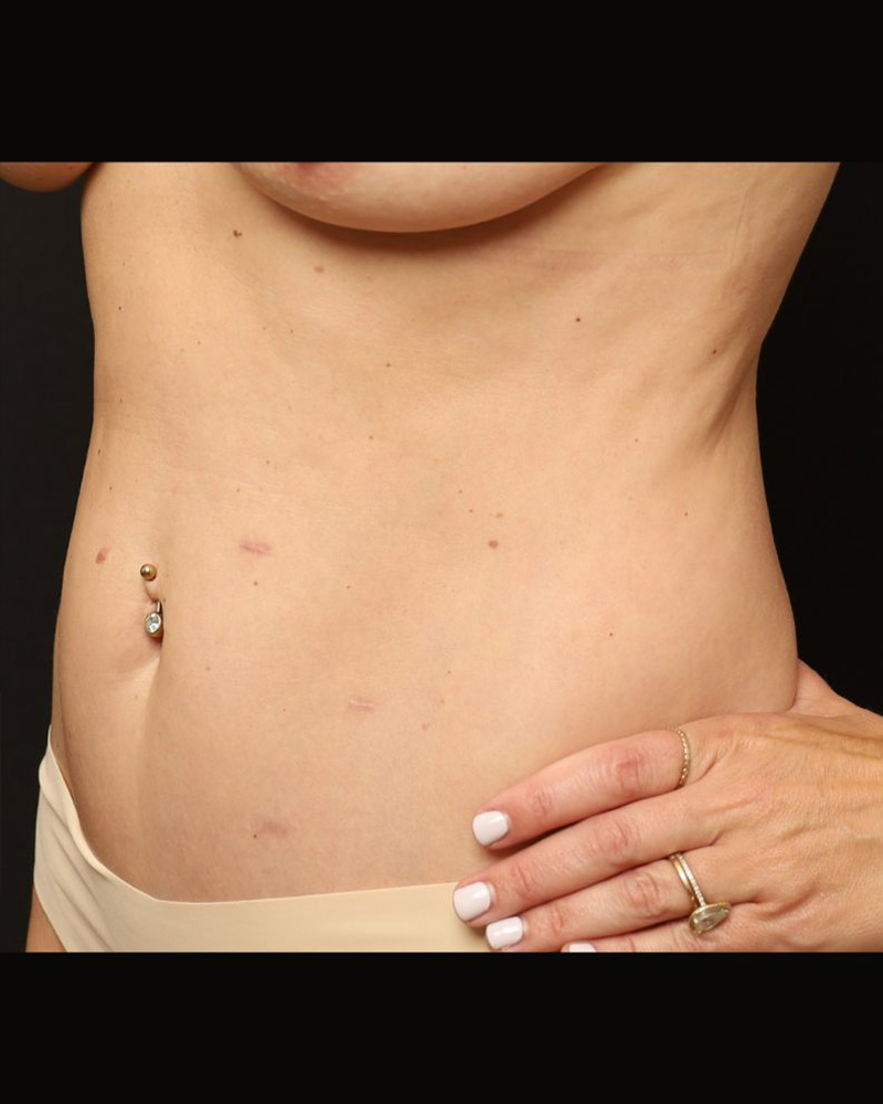 Tummy Tuck Before and After 09