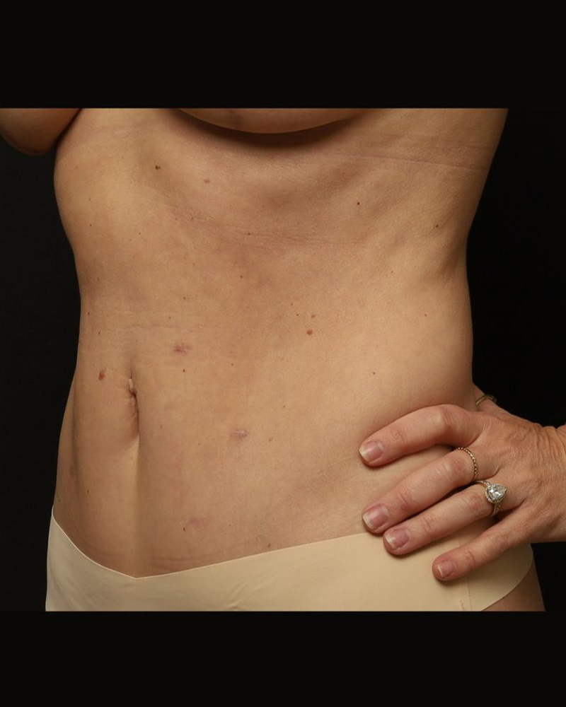 Tummy Tuck Before and After 09