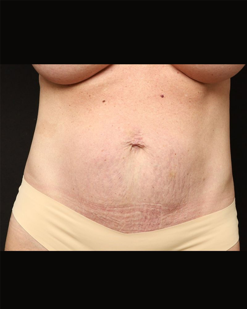 Tummy Tuck Before and After 10