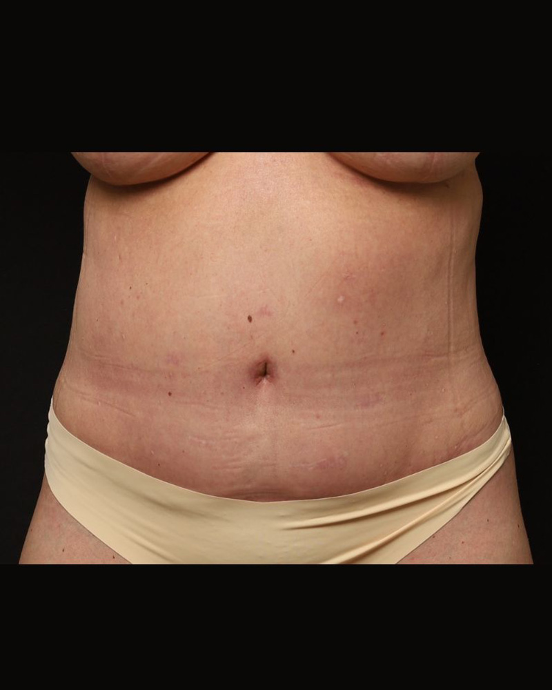 Tummy Tuck Before and After 07