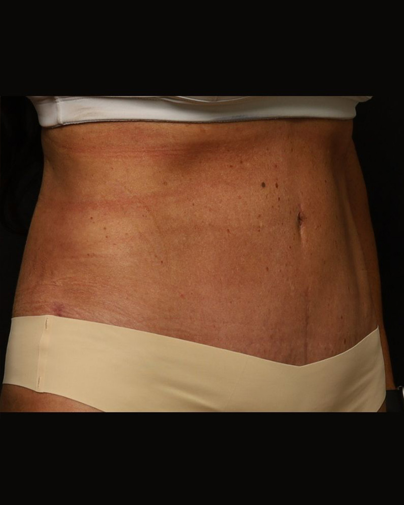 Tummy Tuck Before and After 10