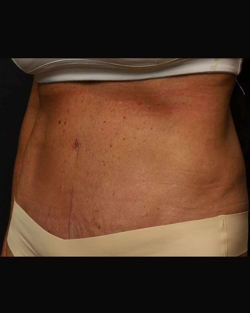 Tummy Tuck Before and After 10
