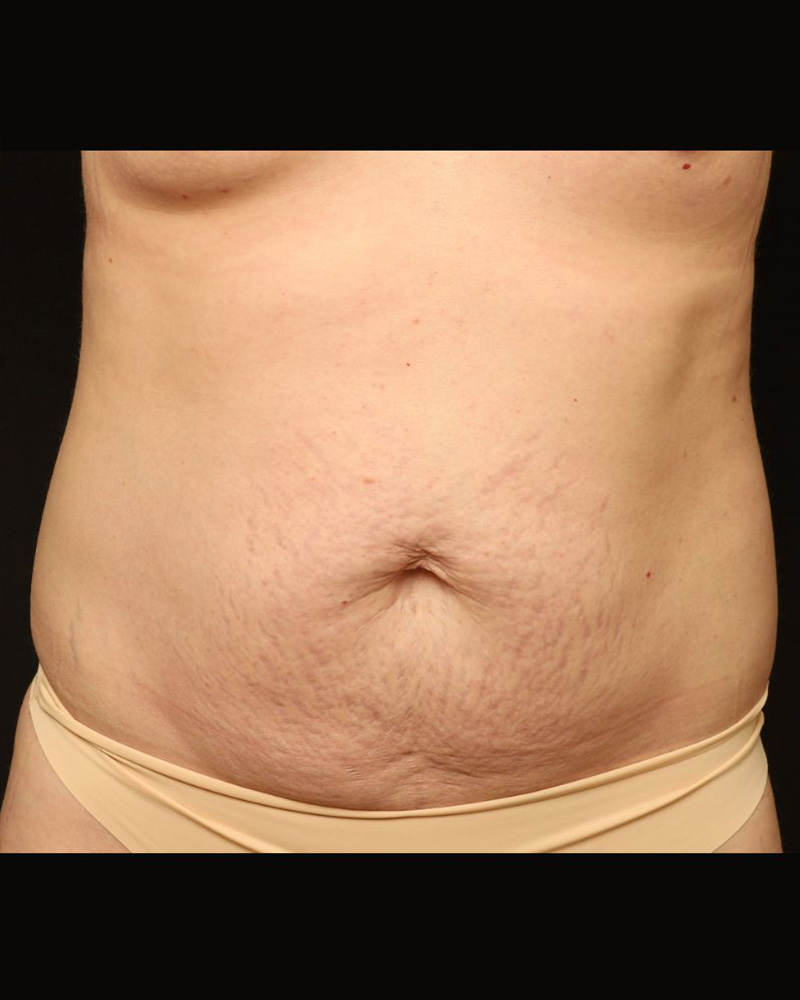 Tummy Tuck Before and After 11