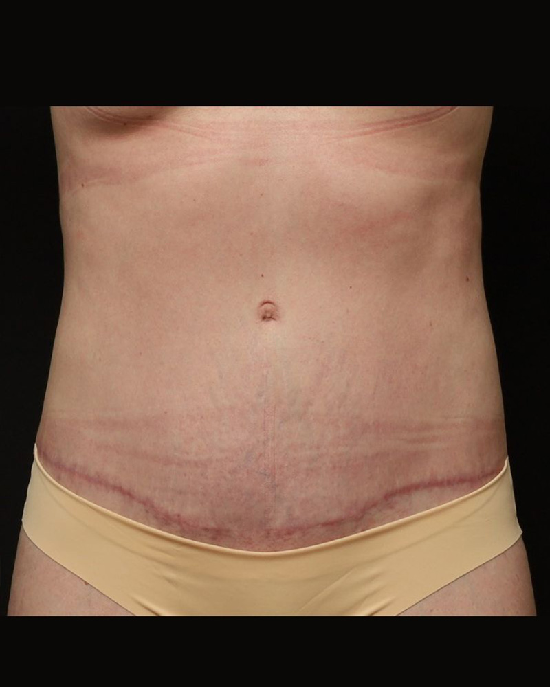 Tummy Tuck Before and After 07