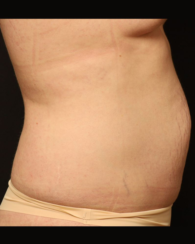 Tummy Tuck Before and After 11