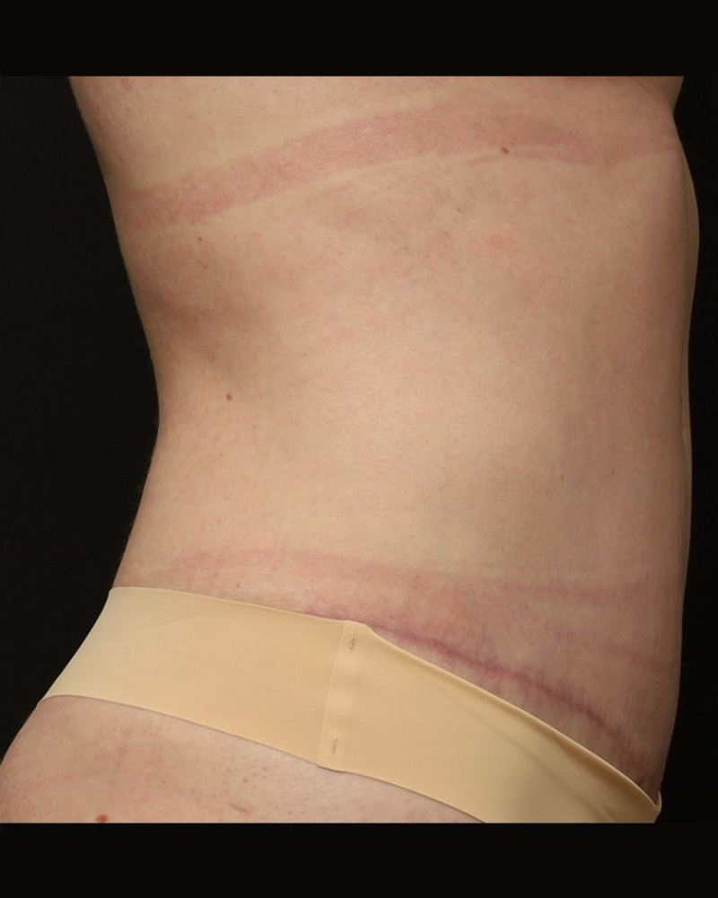 Tummy Tuck Before and After 11