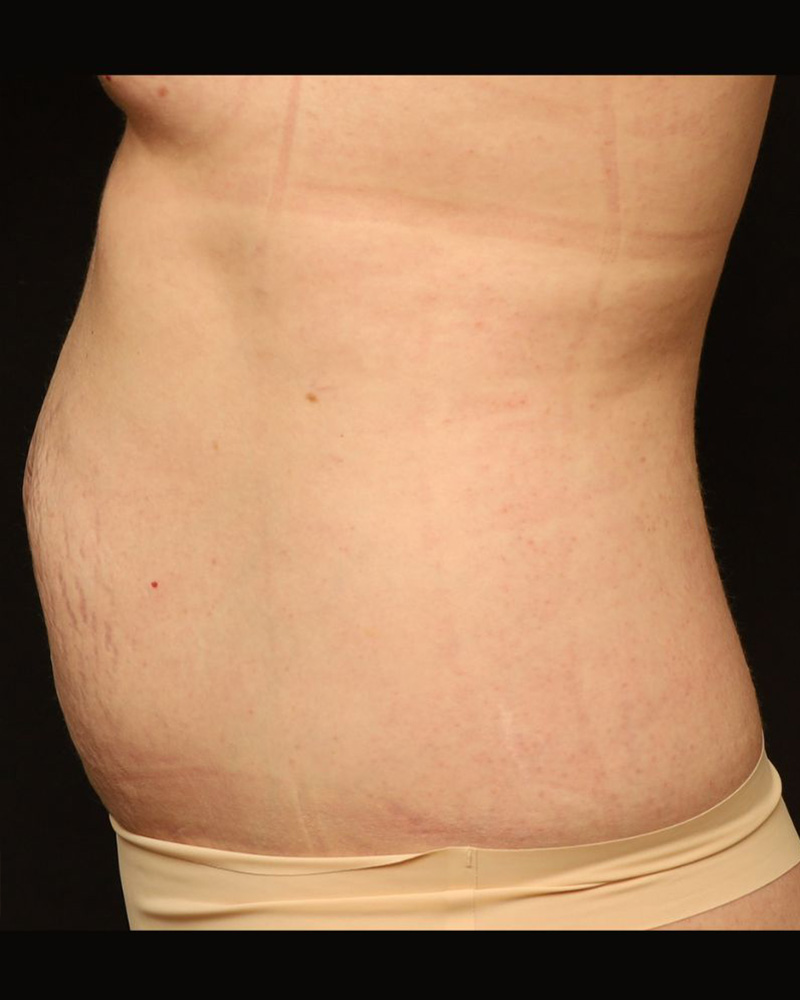 Tummy Tuck Before and After 11