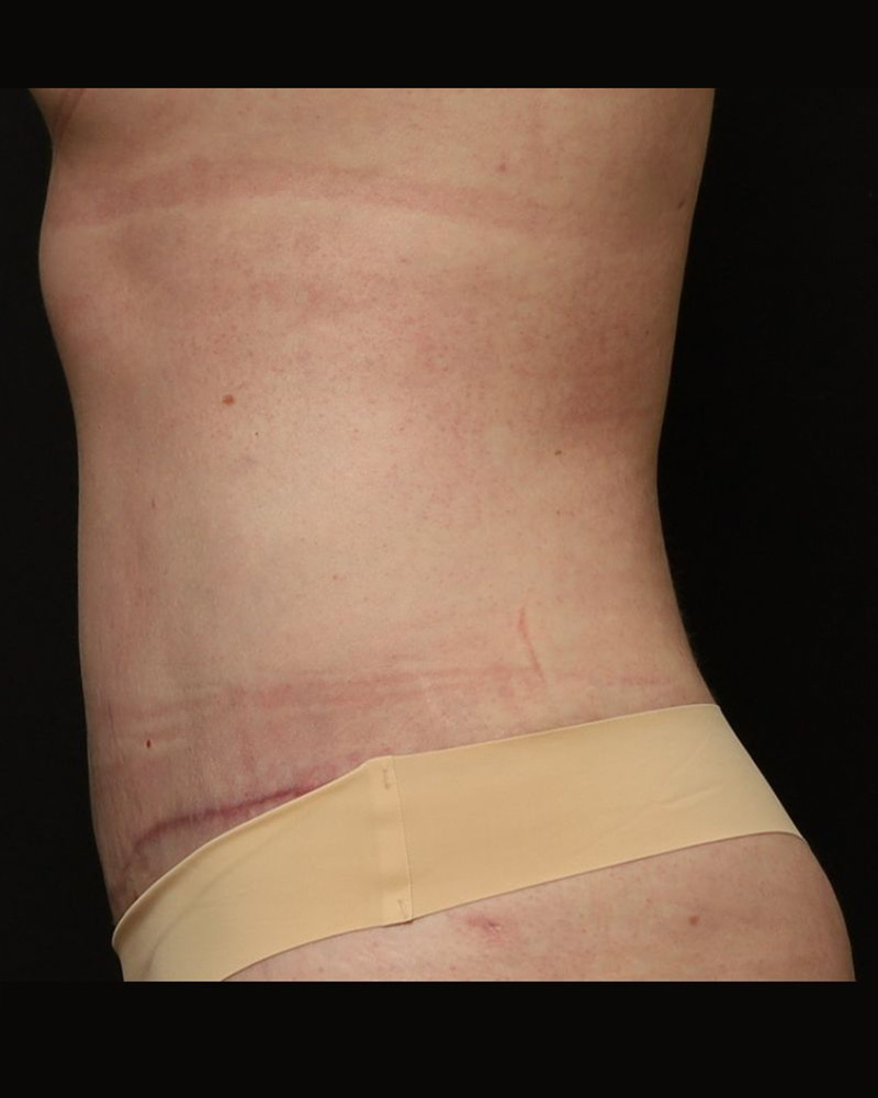 Tummy Tuck Before and After 11