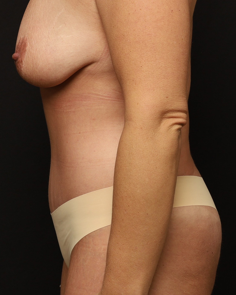 Tummy Tuck Before and After 12