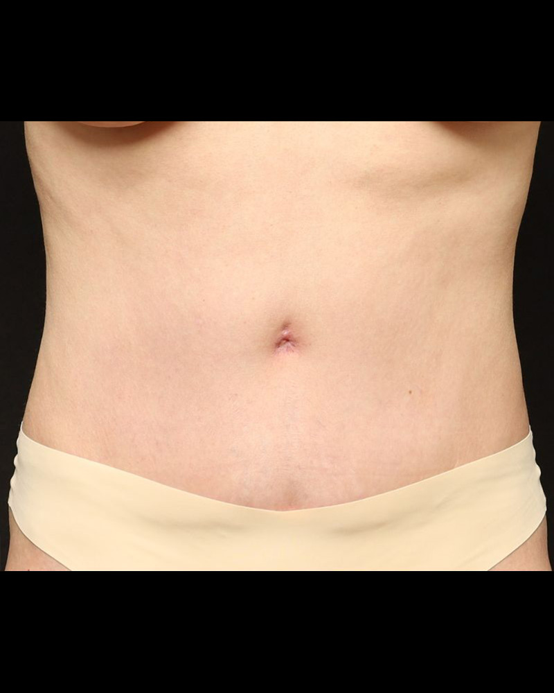 Tummy Tuck Before and After 07