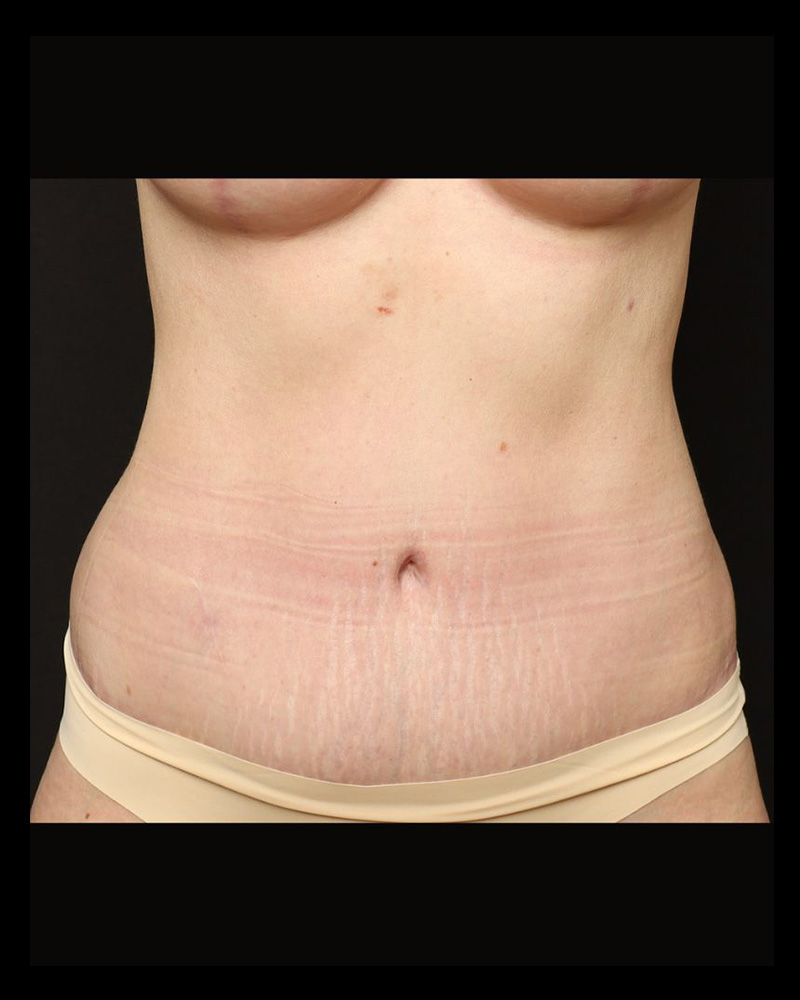 Tummy Tuck Before and After 07