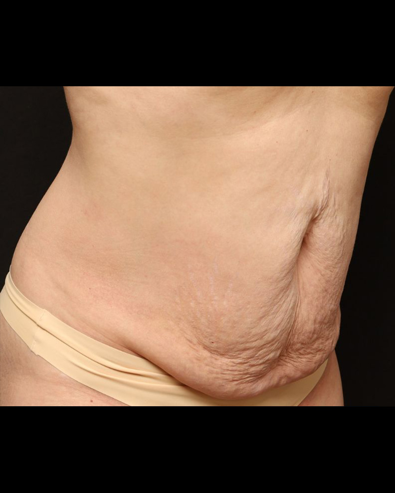 Tummy Tuck Before and After 15