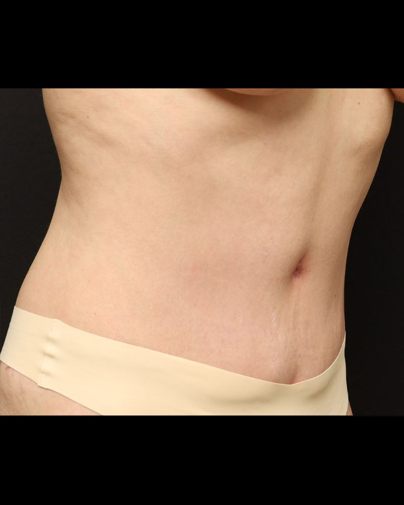 Tummy Tuck Before and After 15