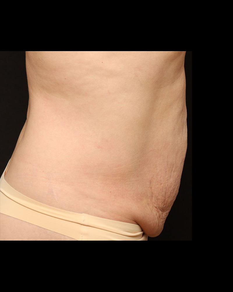 Tummy Tuck Before and After 15