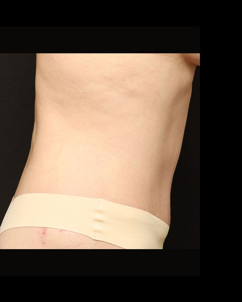 Tummy Tuck Before and After 15