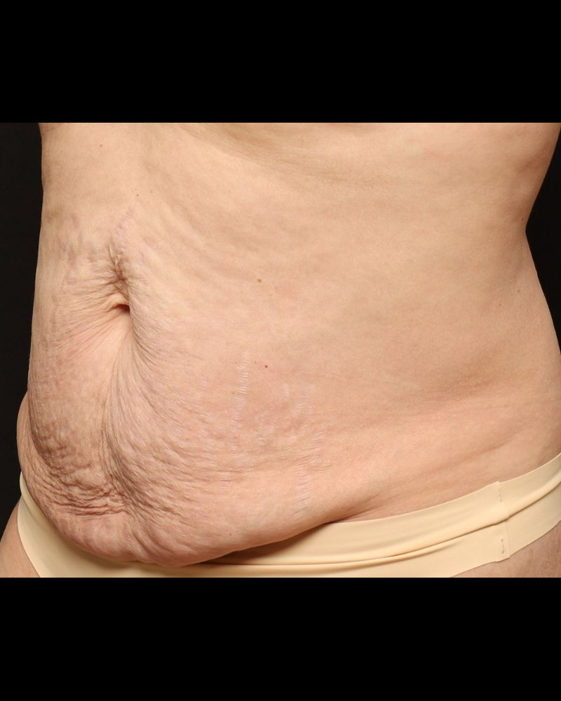 Tummy Tuck Before and After 15