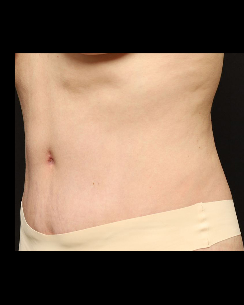 Tummy Tuck Before and After 15