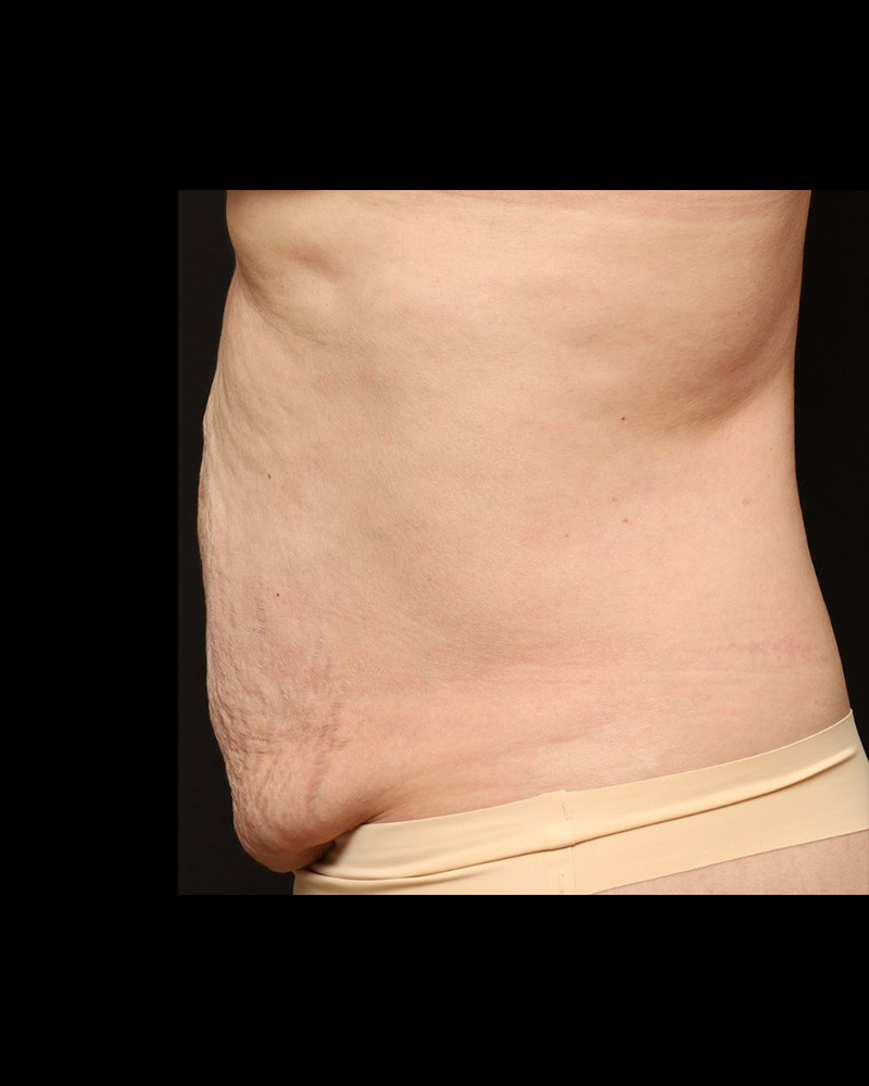 Tummy Tuck Before and After 15