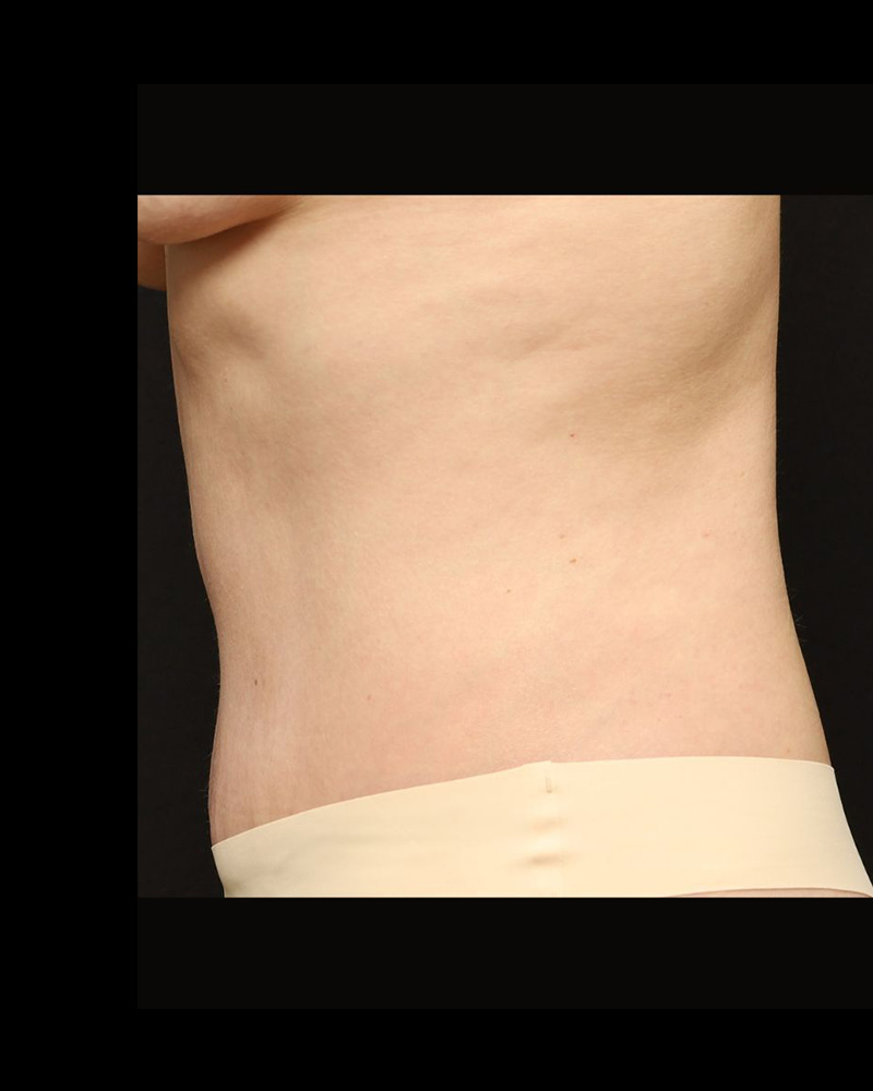 Tummy Tuck Before and After 15