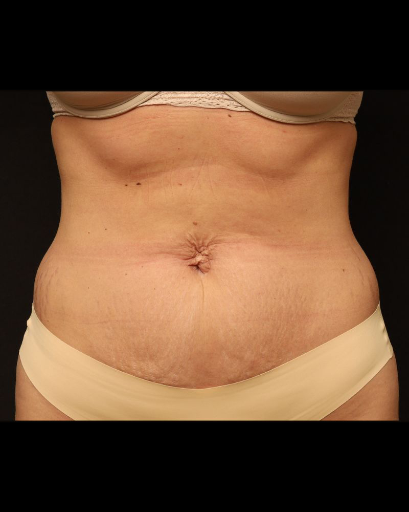 Tummy Tuck Before and After 16