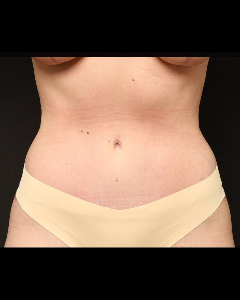 Tummy Tuck Before and After 07