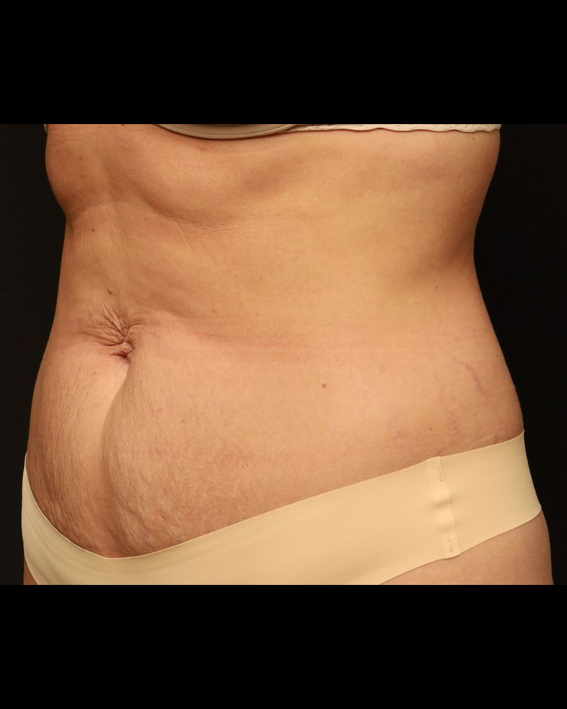 Tummy Tuck Before and After 16
