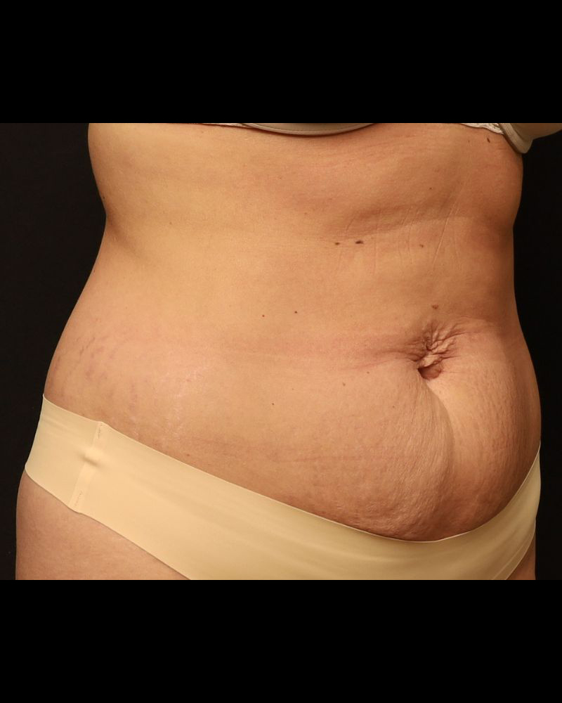 Tummy Tuck Before and After 16
