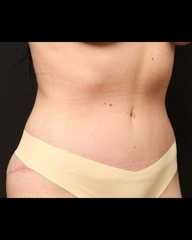 Tummy Tuck Before and After 16
