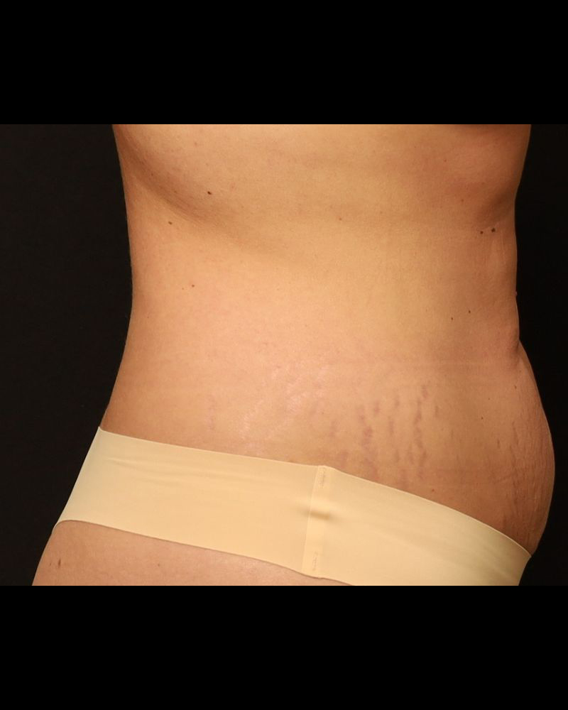 Tummy Tuck Before and After 16