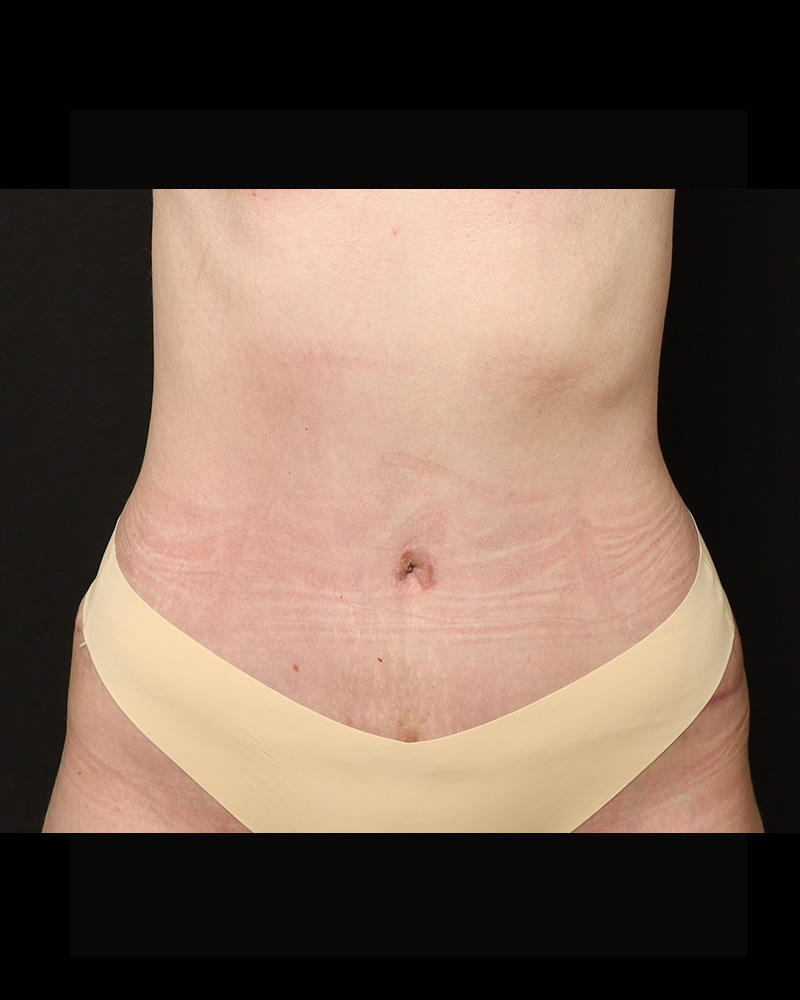 Tummy Tuck Before and After 07